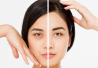 young pretty girl eyebrows lifted injections browplasty