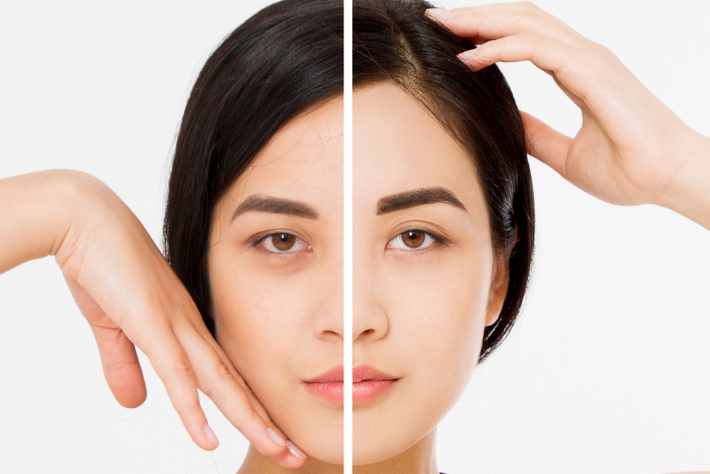 Brow Lift vs. Eyelid Surgery: Which Is Right for You?