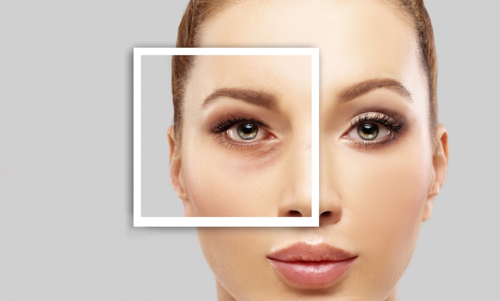 The Road to Radiant Eyes: Recovering from Blepharoplasty