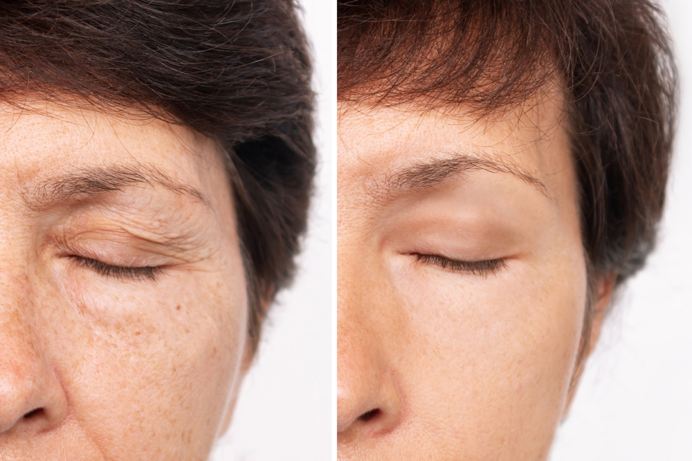 Drooping Eyelids: Causes and Solutions