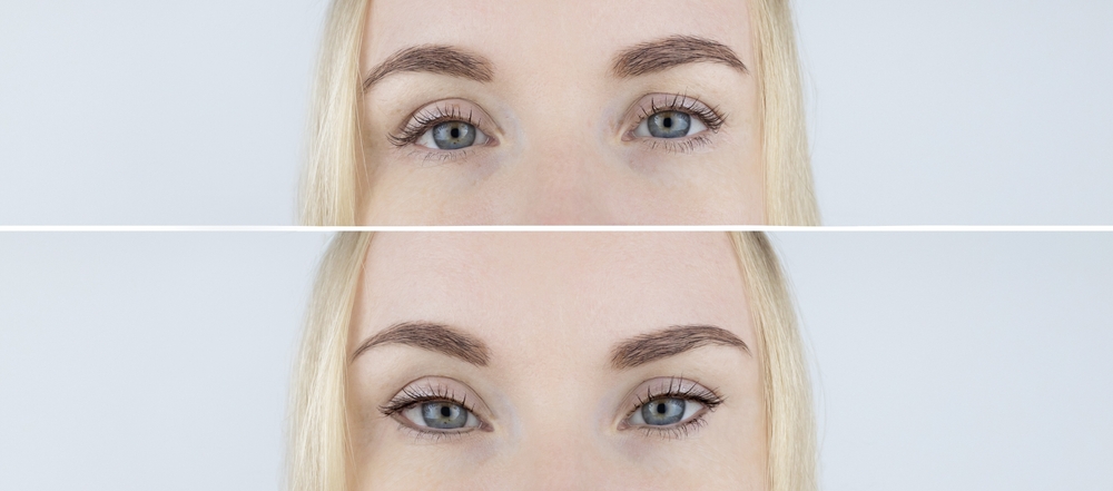 Brow Lifts and the 'Fox Eye' Trend: What You Need to Know Before You Try It