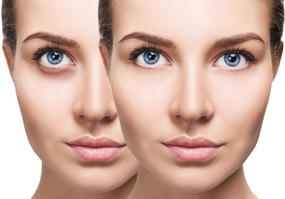 Under-Eye Bags: Why They Happen and How They Can Be Treated