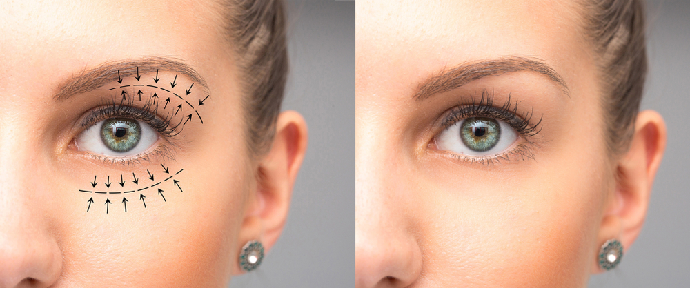 Upper vs. Lower Eyelid Surgery: Understanding the Difference