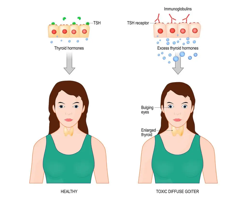 How Thyroid Eye Disease Can Change Your Eyelids: Symptoms, Evaluation, and Treatment