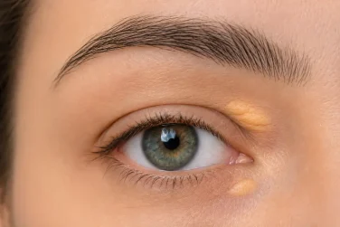 Yellow Patches on Your Eyelids? What to Know About Xanthelasma